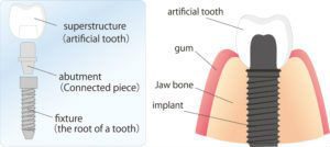 Diagram of the parts of a dental implant and the jaw. 